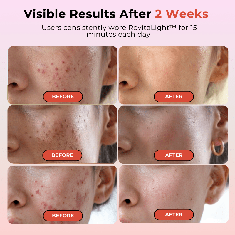 RevitaLight™ Therapy Face Mask