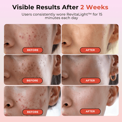 RevitaLight™ Therapy Face Mask